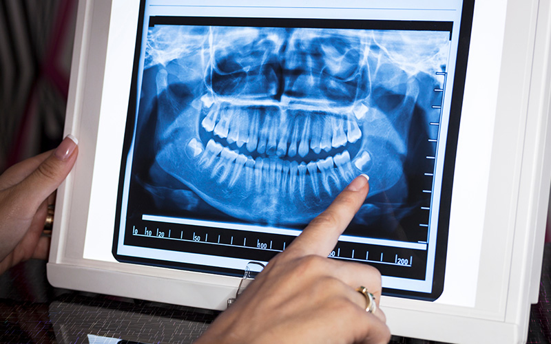 A person s hand pointing at a dental x-ray image displayed on a computer screen.