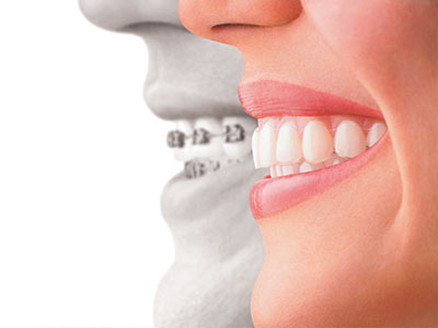 The image features a split-screen comparison of a person s mouth with and without dental implants, highlighting the difference between natural teeth and dental prosthetics.