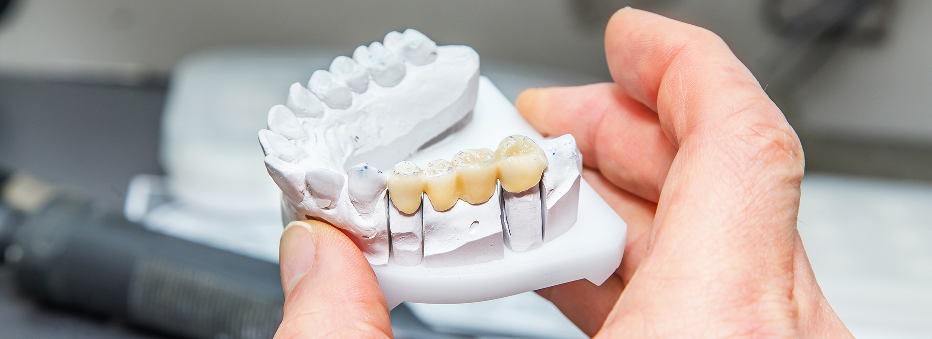 The image shows a person holding a white dental implant with a tooth-like structure attached to it, likely preparing for a dental procedure.