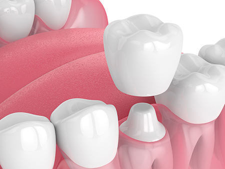The image shows a collection of artificial teeth set against a pink background, with an overlay of a digital watermark or text that reads  Trophy.