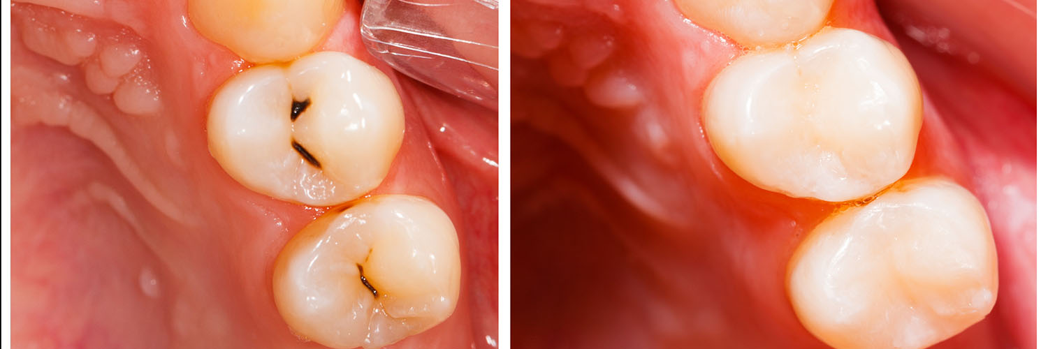 The image shows a close-up view of a human mouth with teeth, gums, and tongue visible, featuring an area where dental work appears to be underway or has been completed.