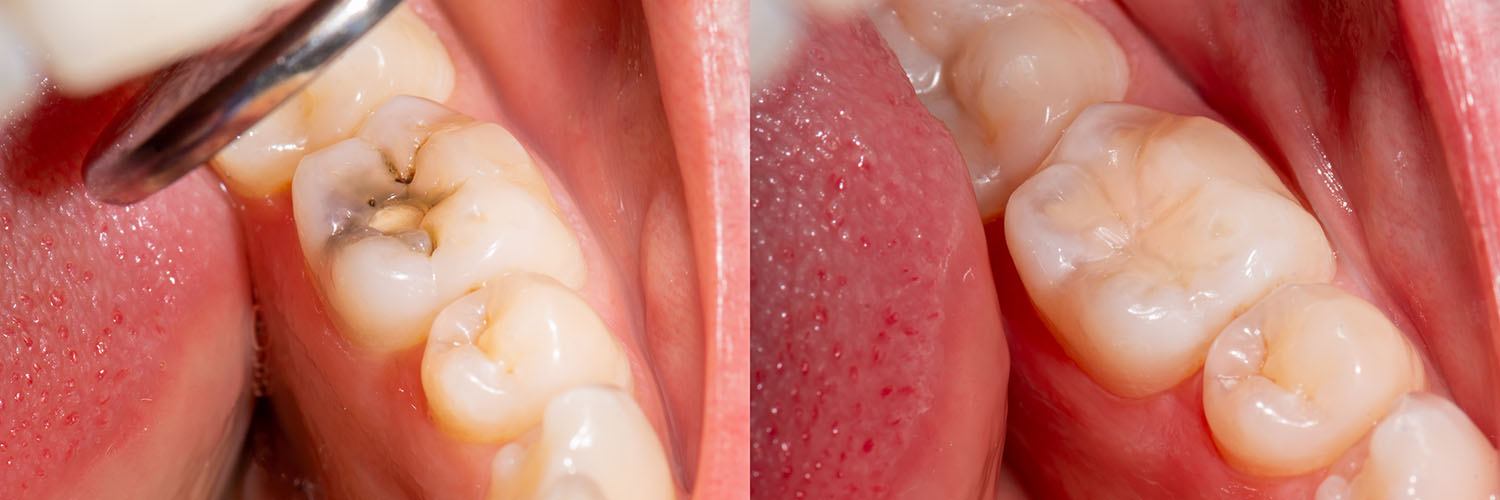Close-up view of dental implants with a focus on the surgical process.