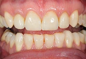 The image shows a close-up view of a person s teeth and gums with visible yellowing and staining, suggesting poor oral hygiene or dental health issues.