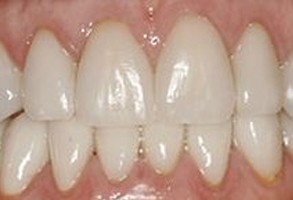The image shows a close-up of a person s teeth with a focus on a yellowish discoloration, possibly indicating poor oral hygiene or dental issues.