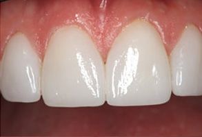 The image shows a close-up of a person s teeth with a focus on dental restoration work, featuring a white filling and a visible crown.