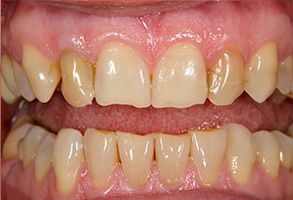 The image shows two photos of a person s mouth with teeth showing signs of decay and discoloration, likely due to poor oral hygiene or dental issues.